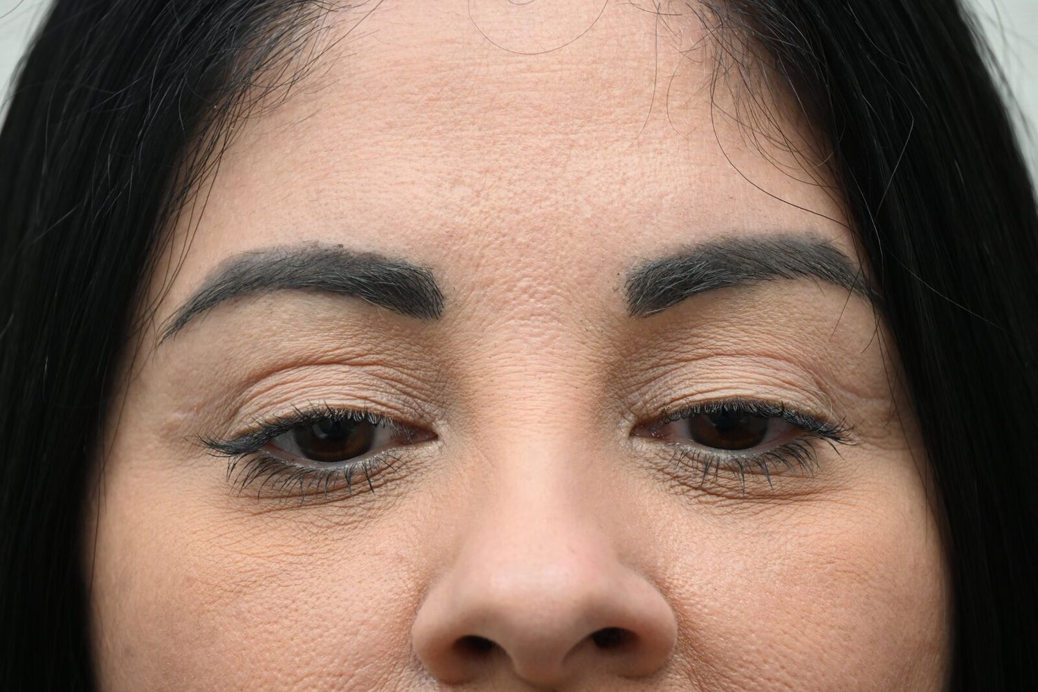 Blefaroplastia Before & After