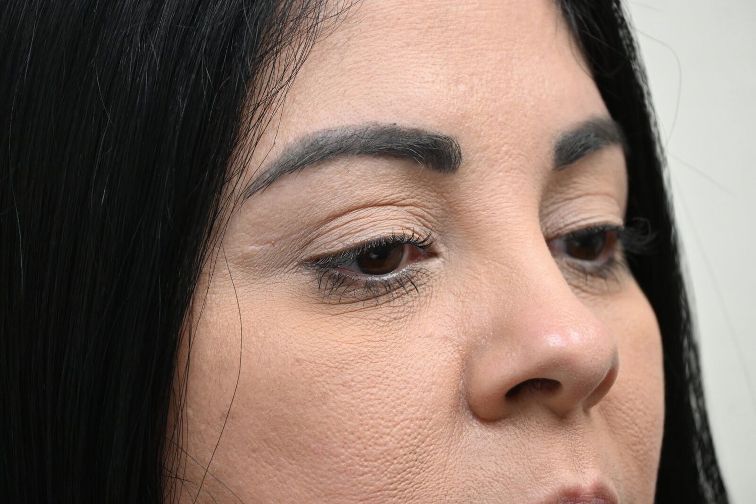 Blefaroplastia Before & After