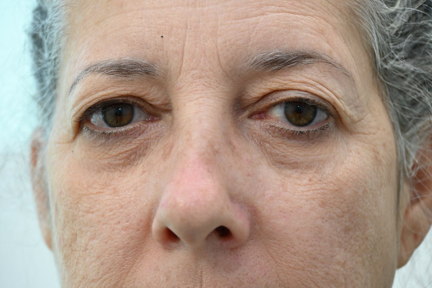Blefaroplastia Before & After
