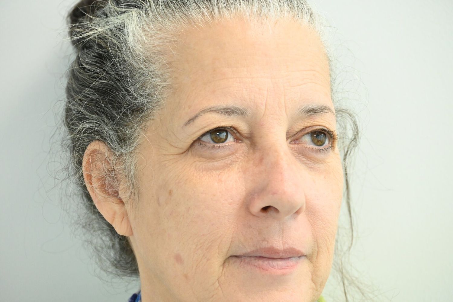 Blefaroplastia Before & After