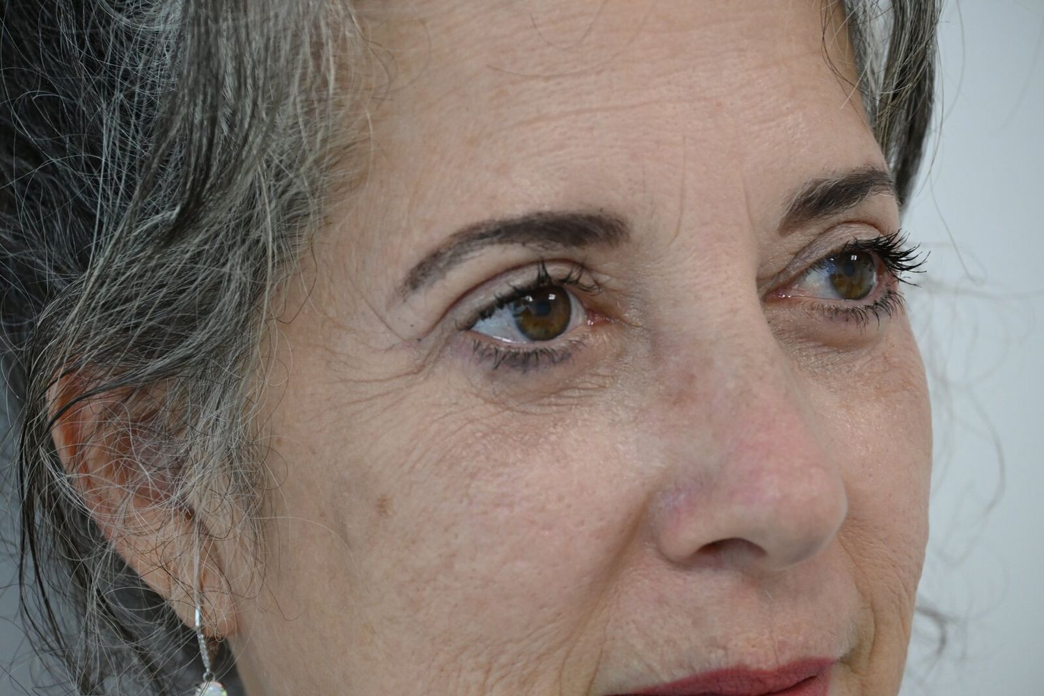 Blefaroplastia Before & After