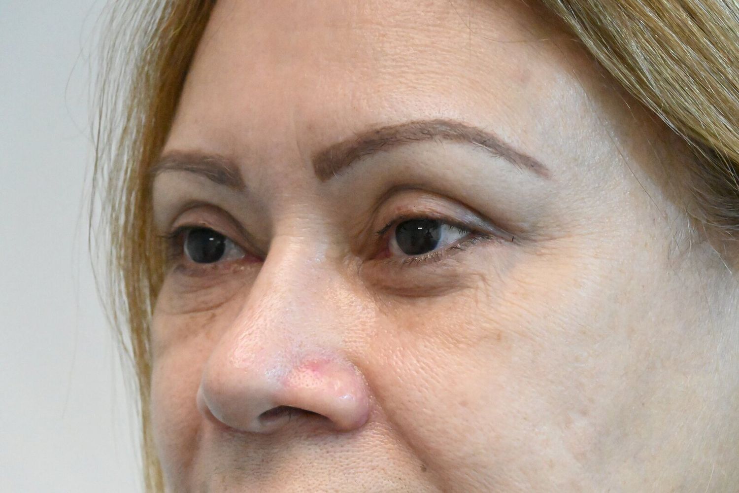 Blefaroplastia Before & After