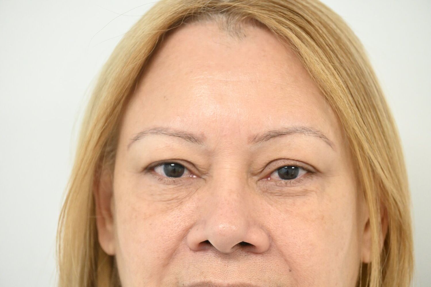 Blefaroplastia Before & After