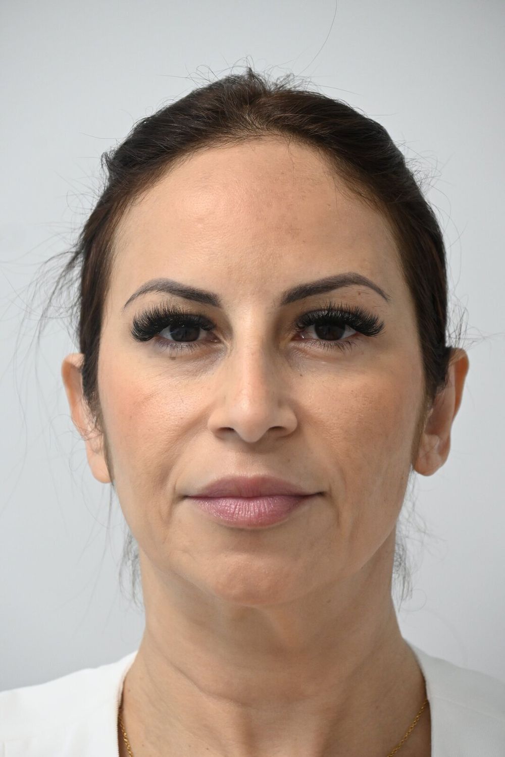 Otoplastia Before & After