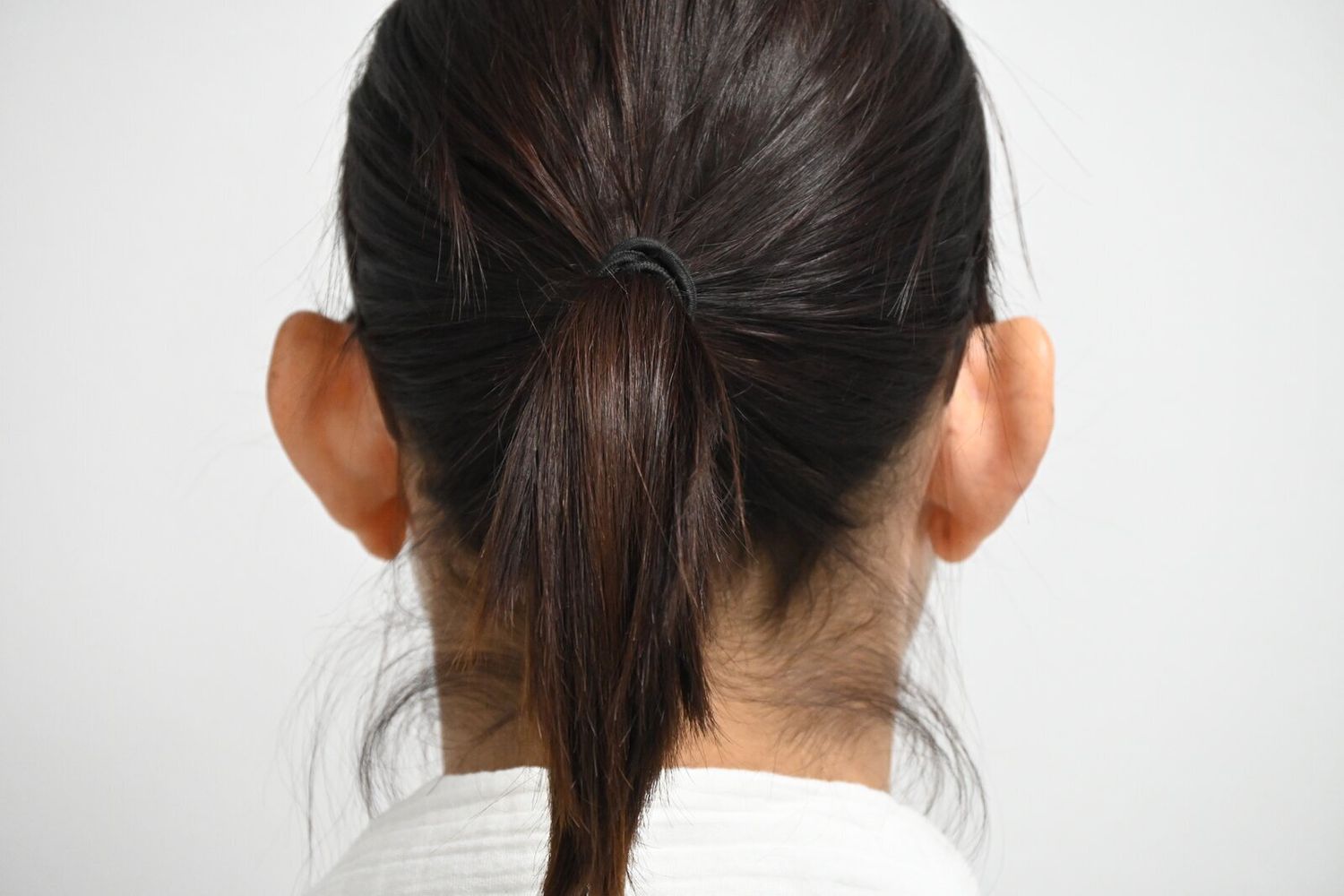 Otoplastia Before & After