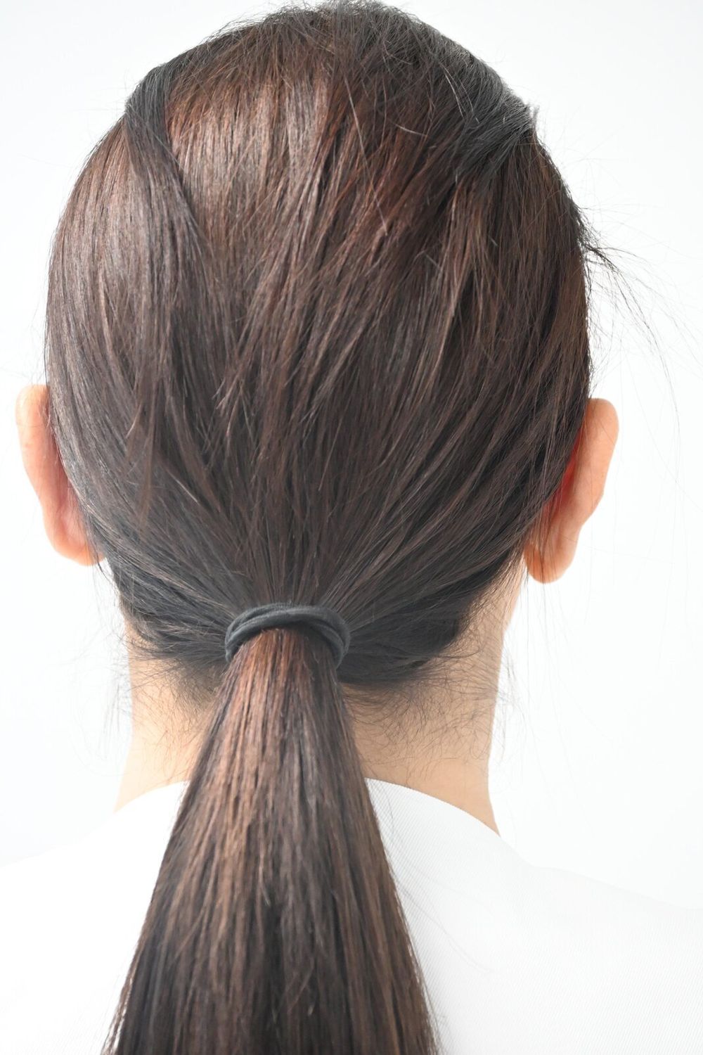 Otoplastia Before & After