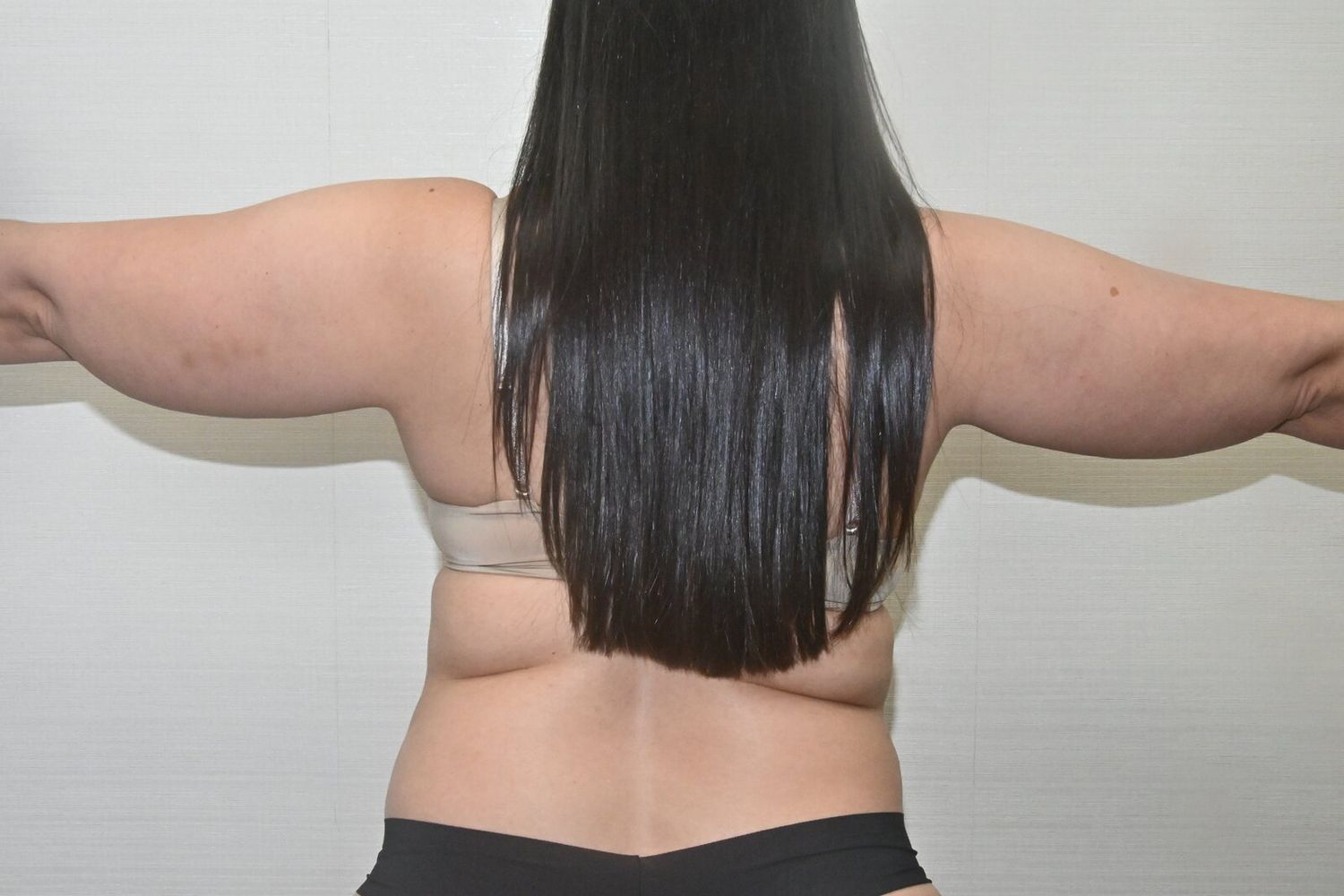 Liposuccion Brazos Before & After