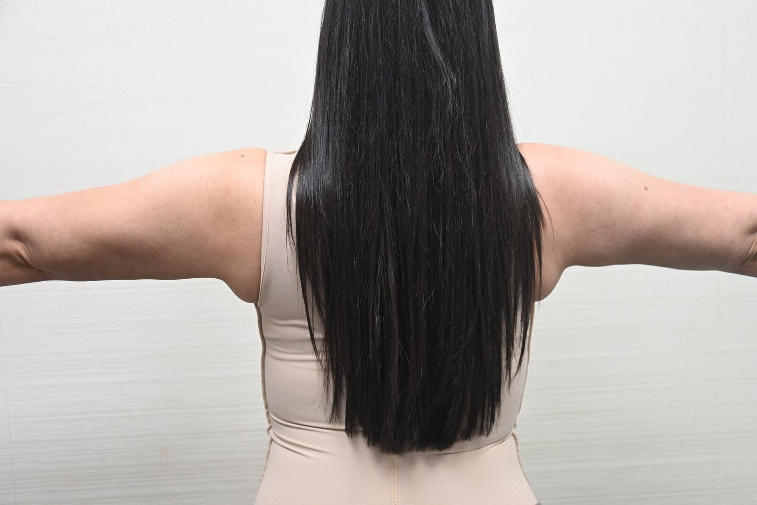 Liposuccion Brazos Before & After