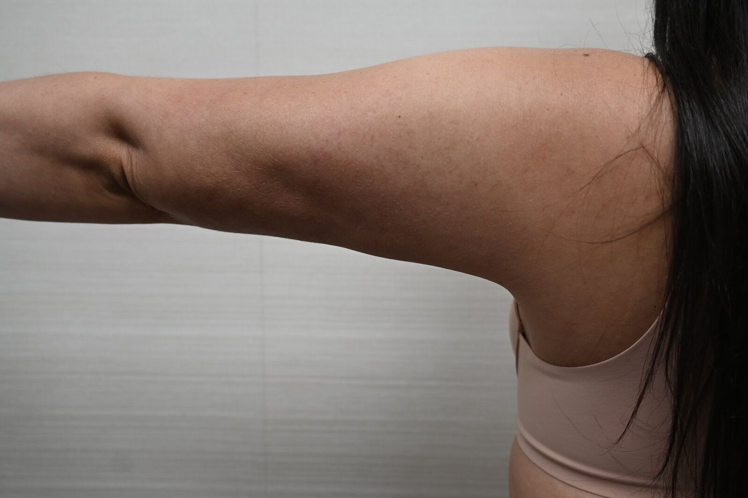 Liposuccion Brazos Before & After