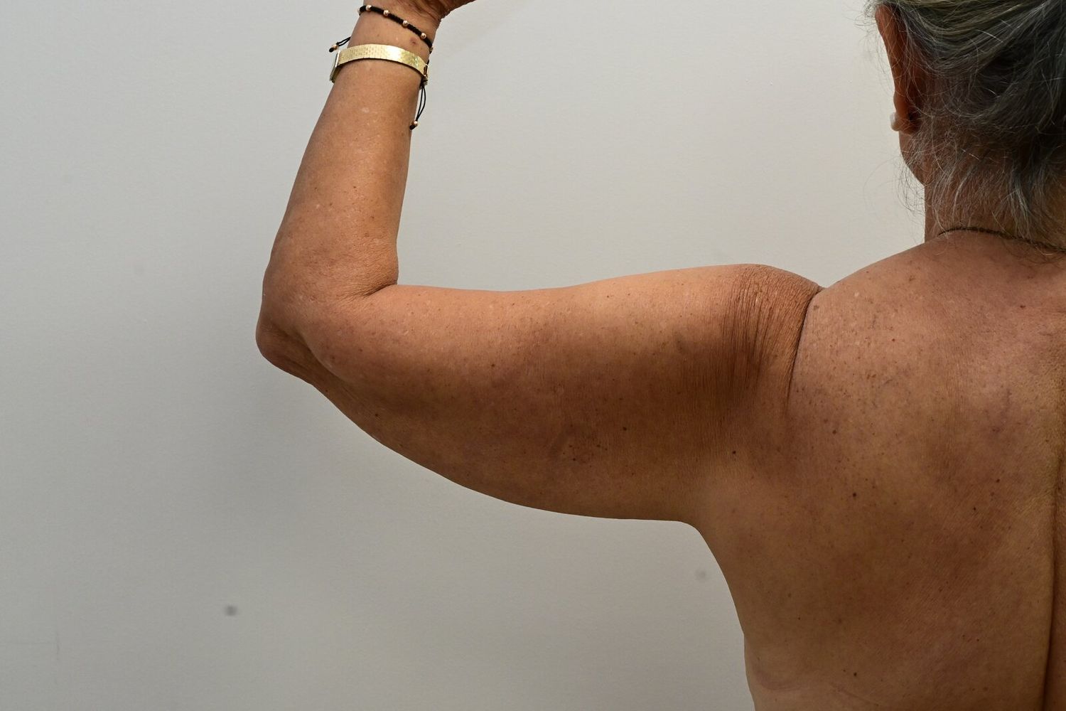 Liposuccion Brazos Before & After