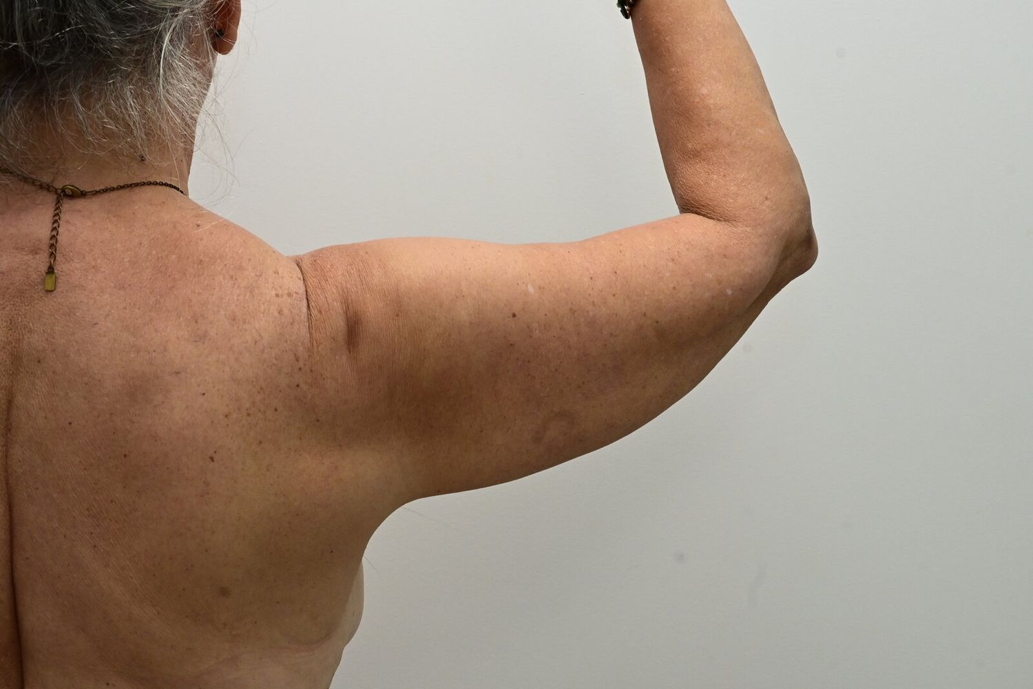 Liposuccion Brazos Before & After