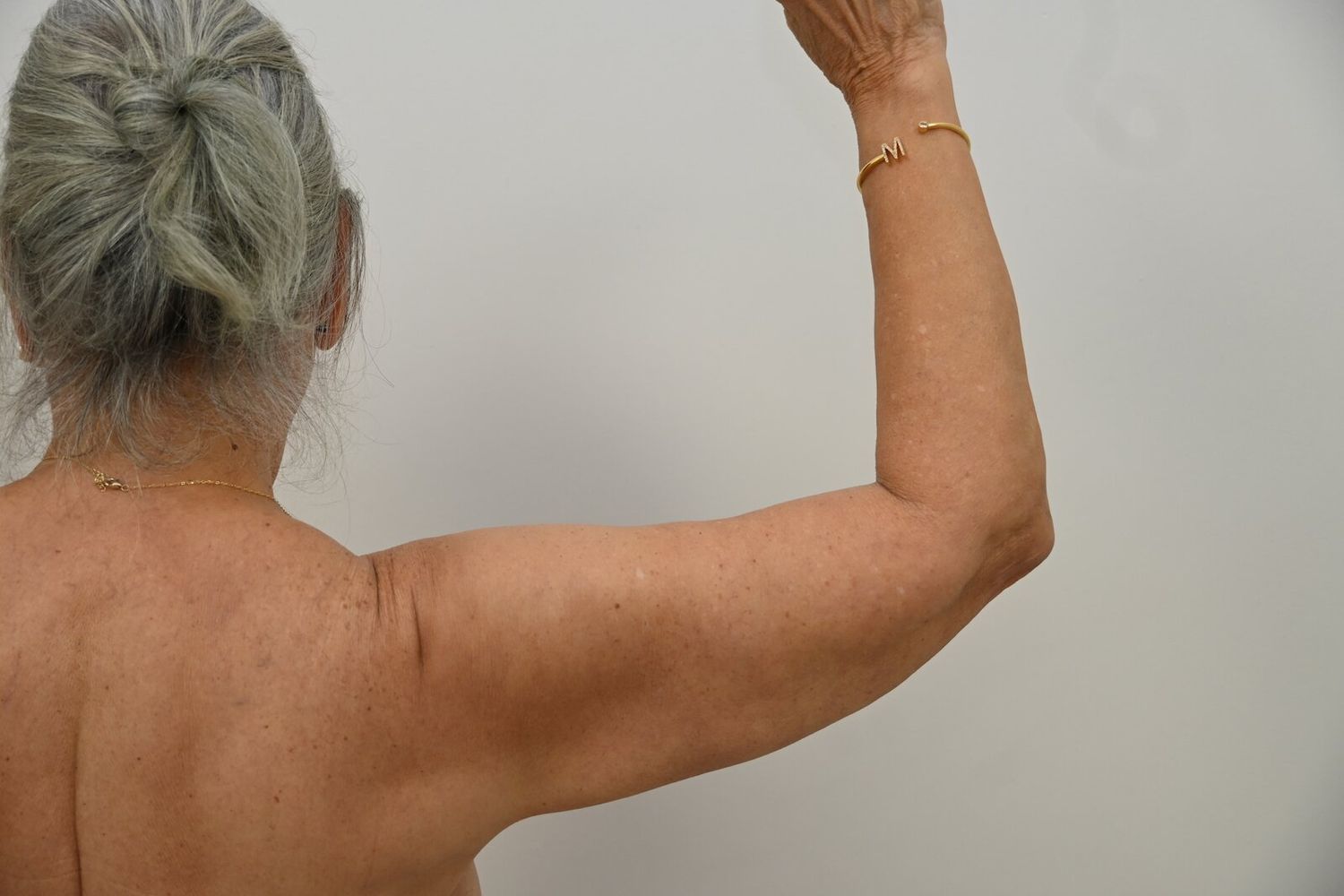 Liposuccion Brazos Before & After