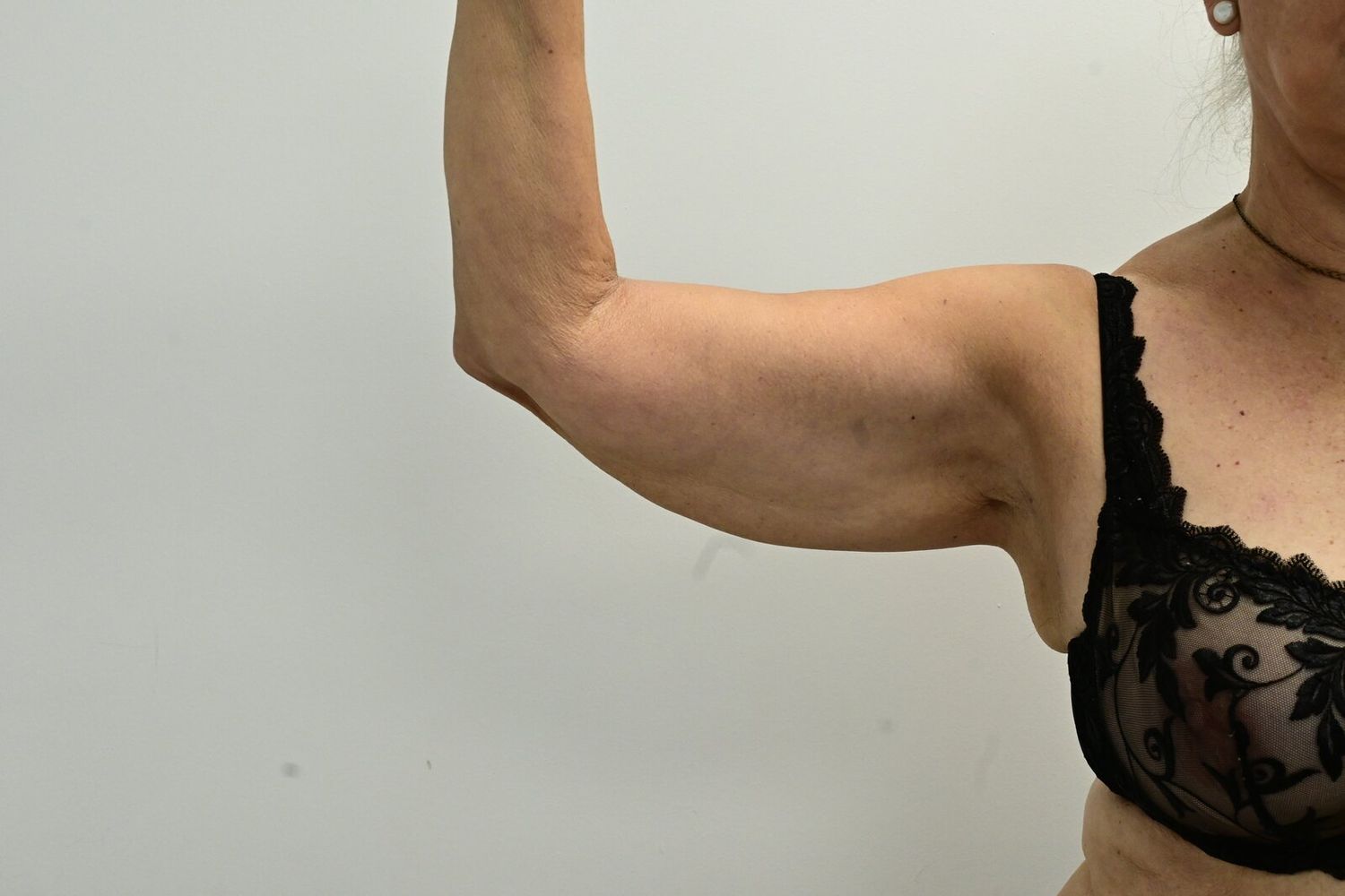 Liposuccion Brazos Before & After