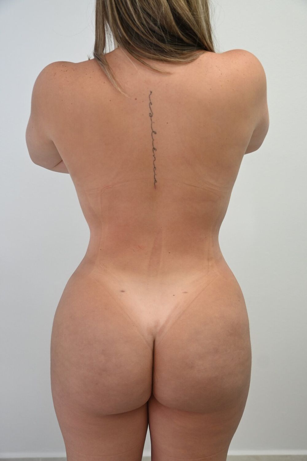 Aumento Gluteos Bbl Before & After