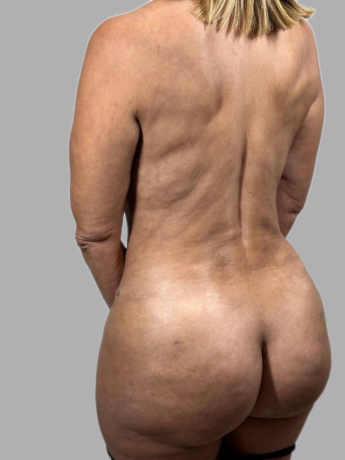 Aumento Gluteos Bbl Before & After