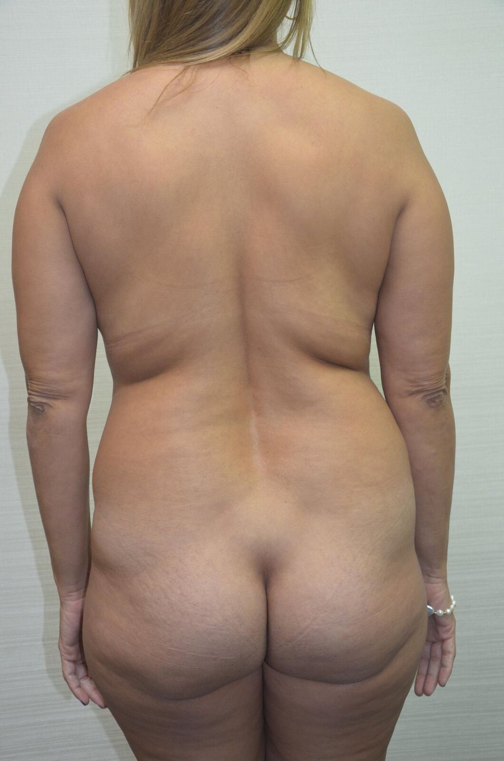 Aumento Gluteos Bbl Before & After