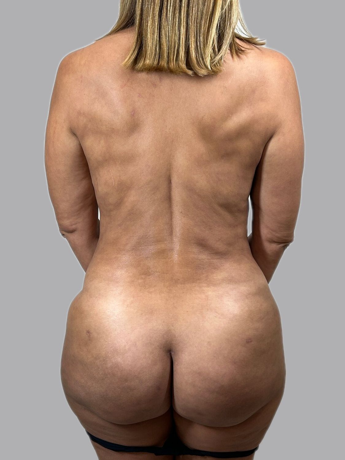 Aumento Gluteos Bbl Before & After