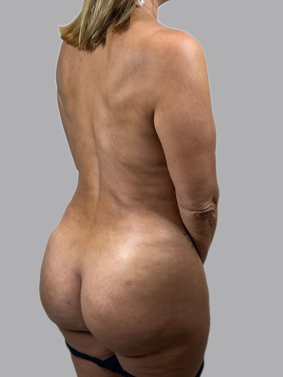Aumento Gluteos Bbl Before & After