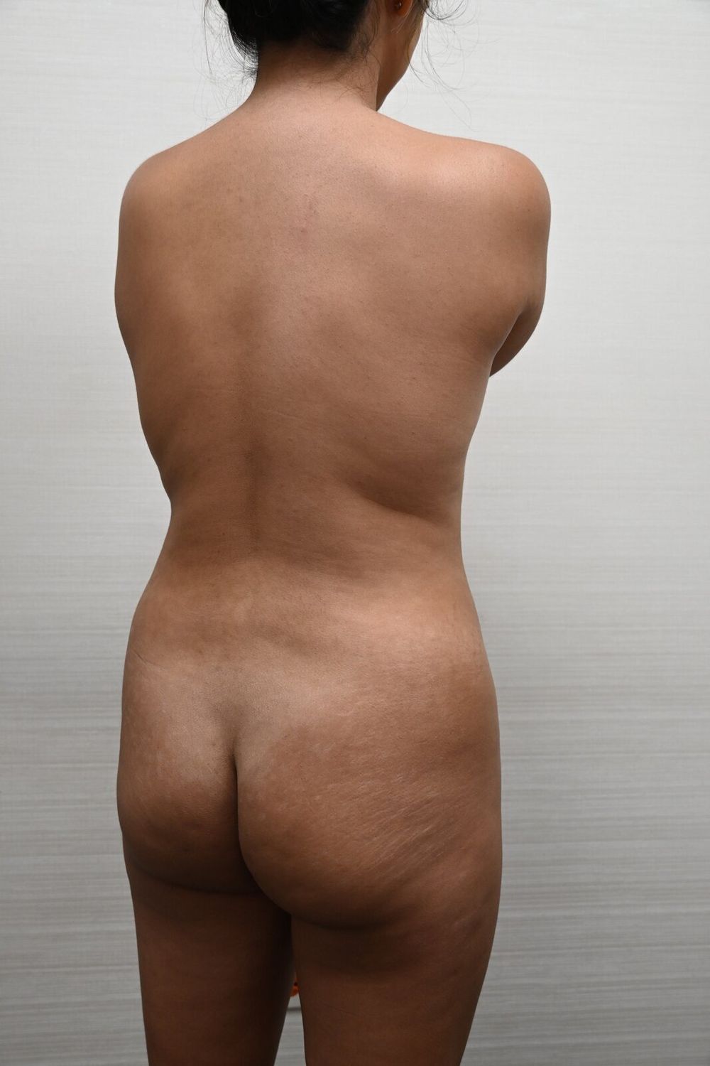 Aumento Gluteos Bbl Before & After
